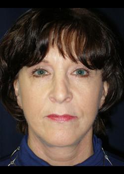 Facelift after at Watterson Plastic Surgery in Draper, UT