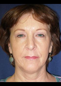 Facelift before at Watterson Plastic Surgery in Draper, UT