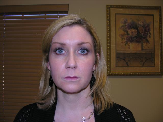 Botox after at VIVA Medspa in Plano, TX