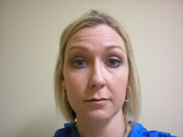 Botox before at VIVA Medspa in Plano, TX