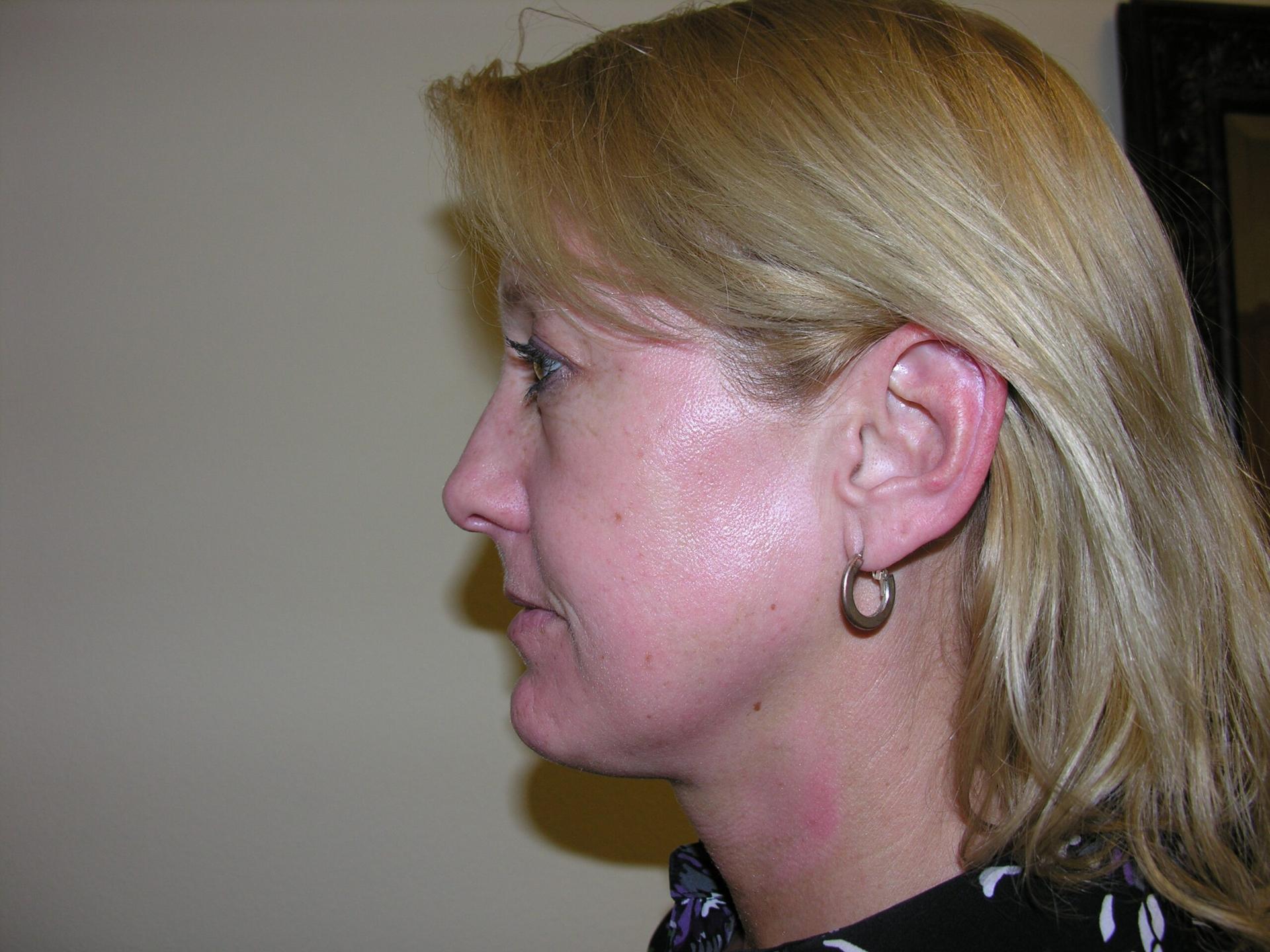 VIVA Medspa after — Plano, TX