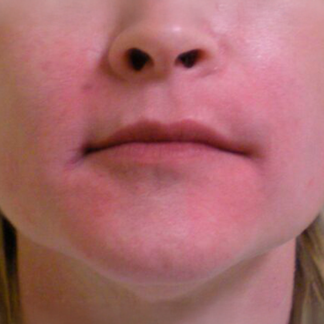 Dermal Fillers after at VIVA Medspa in Plano, TX