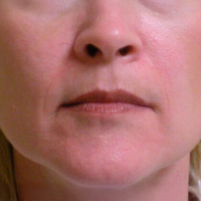 Dermal Fillers before at VIVA Medspa in Plano, TX