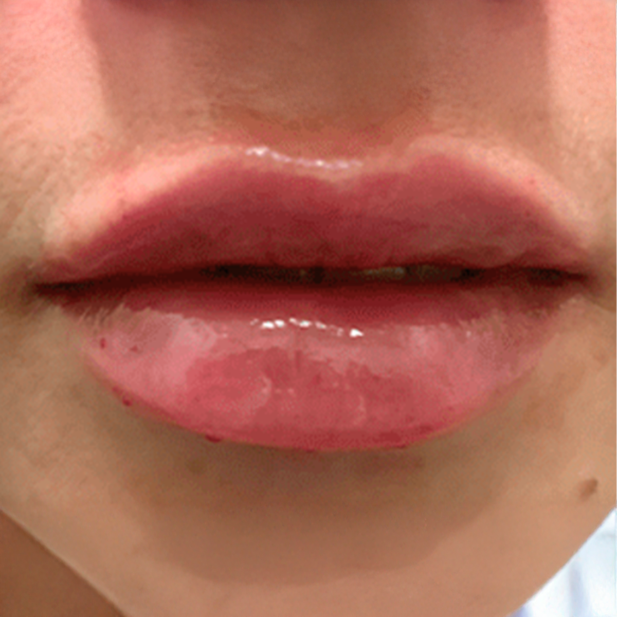 VIVA Medspa lip filler after — Plano, TX