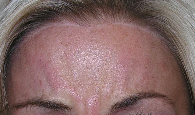Botox before at VIVA Medspa in Plano, TX