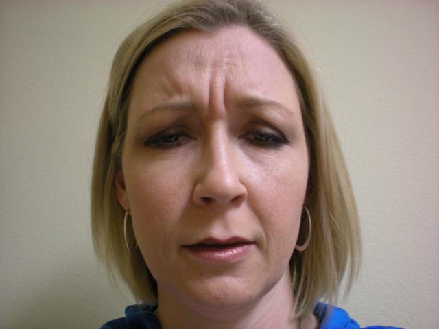 Botox before at VIVA Medspa in Plano, TX