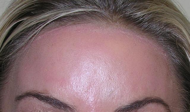 Botox after at VIVA Medspa in Plano, TX
