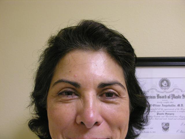 Botox after at VIVA Medspa in Plano, TX