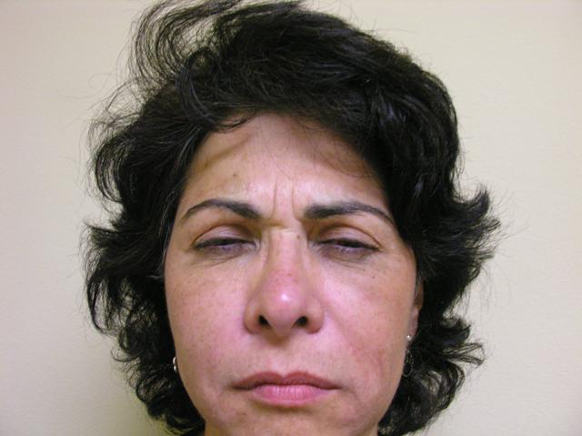 Botox before at VIVA Medspa in Plano, TX
