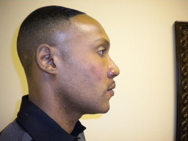 Revision Rhinoplasty after at VIVA Medspa in Plano, TX