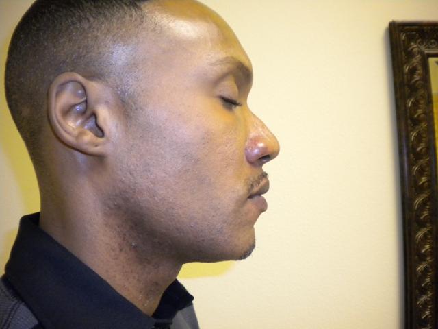 Revision Rhinoplasty before at VIVA Medspa in Plano, TX