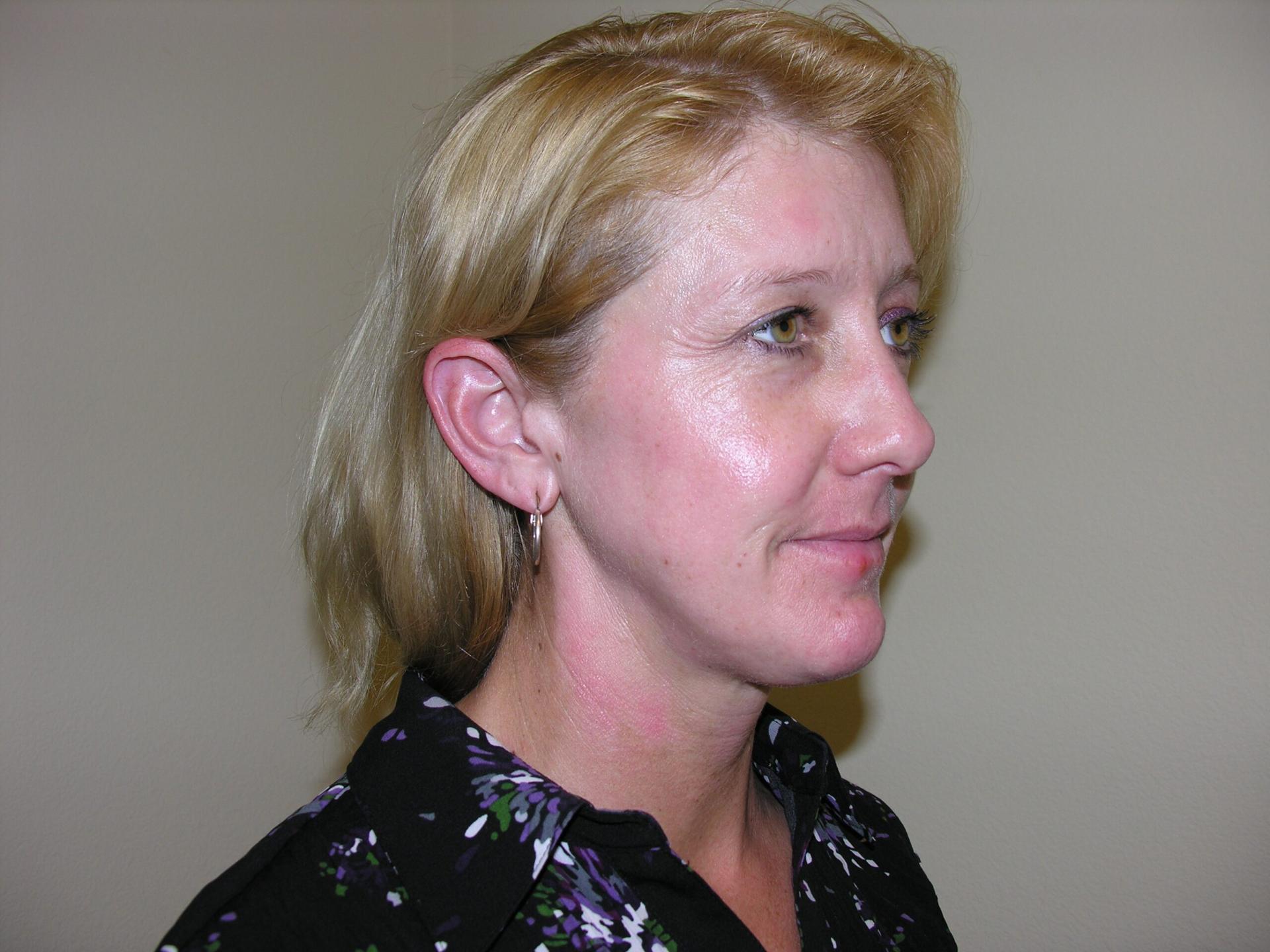 VIVA Medspa after — Plano, TX
