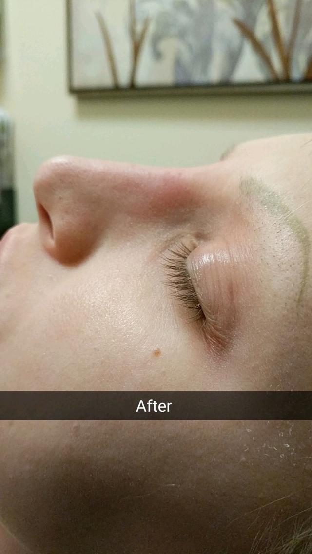 Revision Rhinoplasty after at VIVA Medspa in Plano, TX