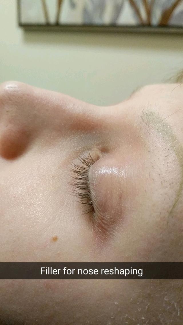 Revision Rhinoplasty before at VIVA Medspa in Plano, TX