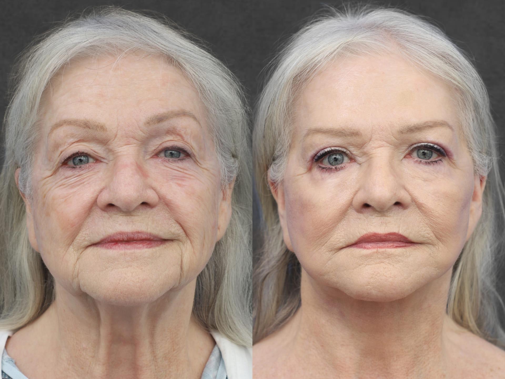 Kameron Rezzadeh, MD facelift result — Beverly Hills, CA