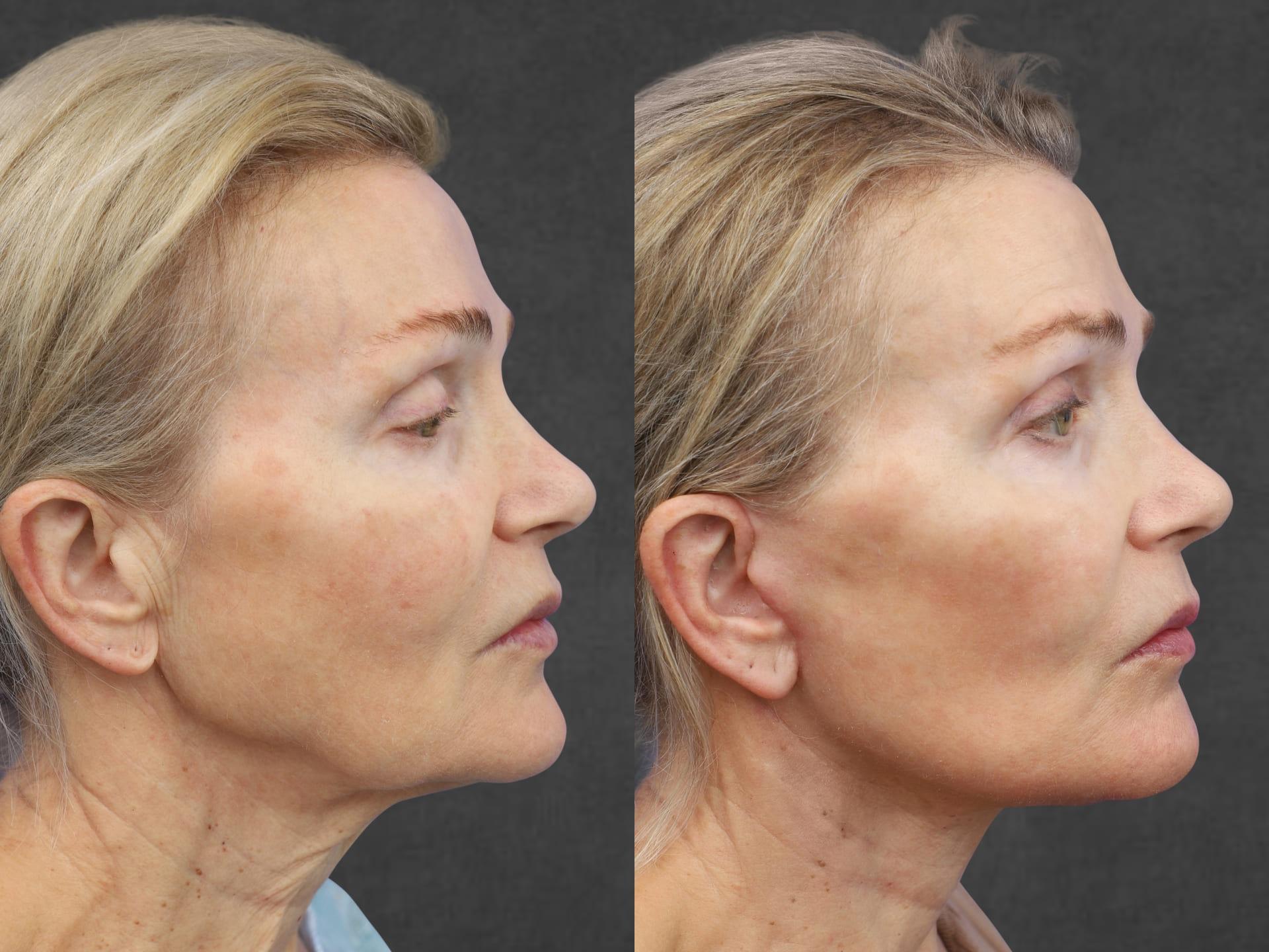 Kameron Rezzadeh, MD facelift result — Beverly Hills, CA