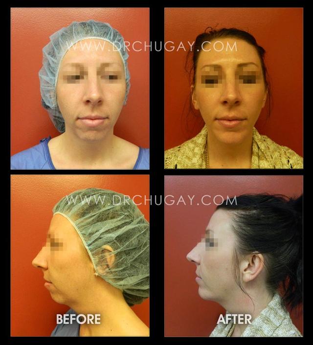 Chin Implant result at Dr. Chugay in Long Beach, CA