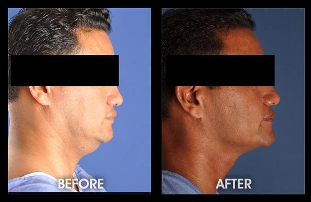Neck Lift result at Dr. Chugay in Long Beach, CA