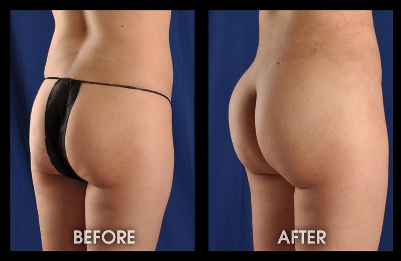 Dr. Chugay bbl result — Long Beach, CA