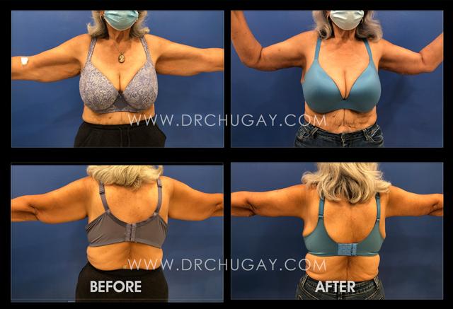 Arm Lift result at Dr. Chugay in Long Beach, CA