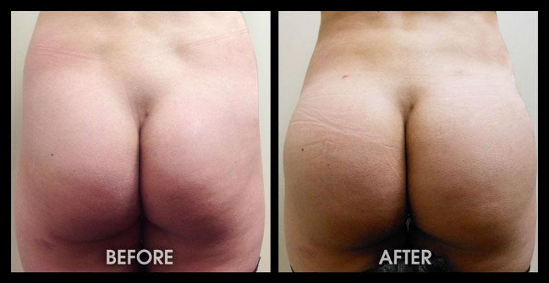 Dr. Chugay bbl result — Long Beach, CA