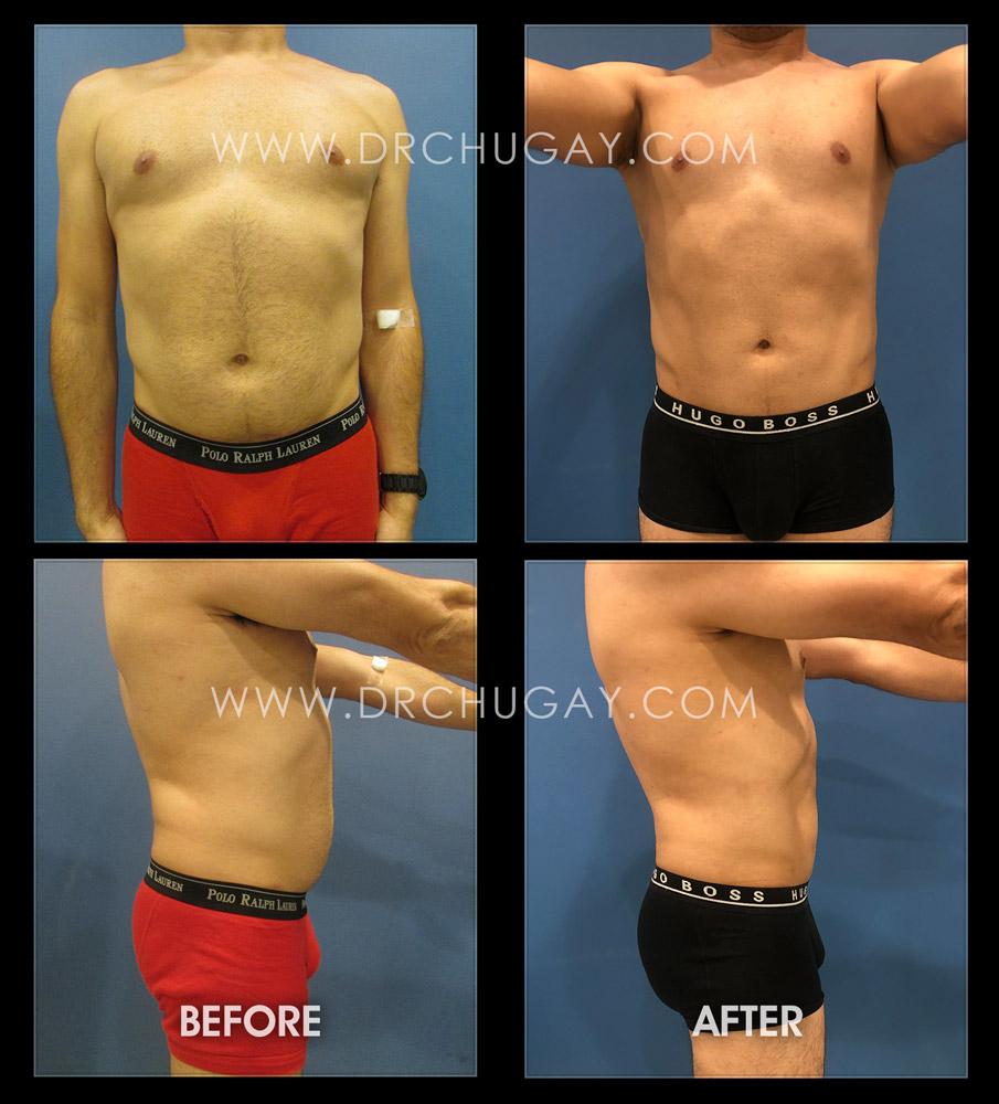 Dr. Chugay bbl result — Long Beach, CA