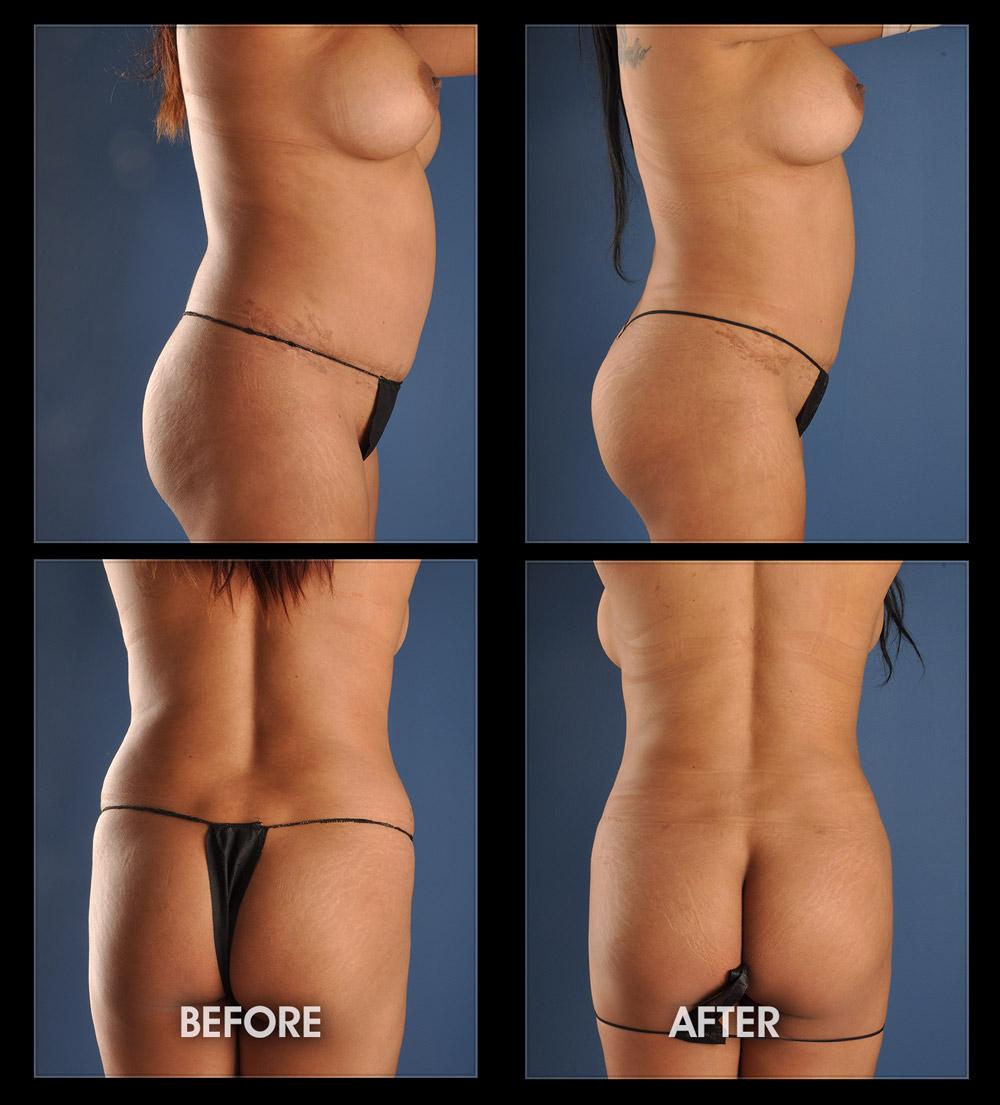 Dr. Chugay bbl result — Long Beach, CA