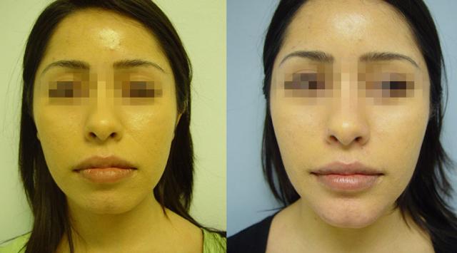 Chin Implant result at Dr. Chugay in Long Beach, CA