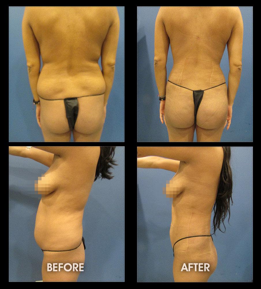 Dr. Chugay bbl result — Long Beach, CA