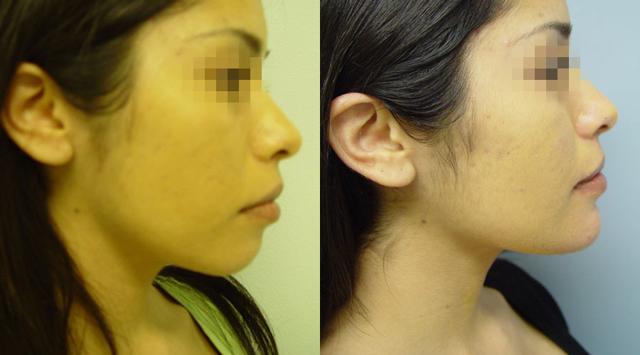 Chin Implant result at Dr. Chugay in Long Beach, CA