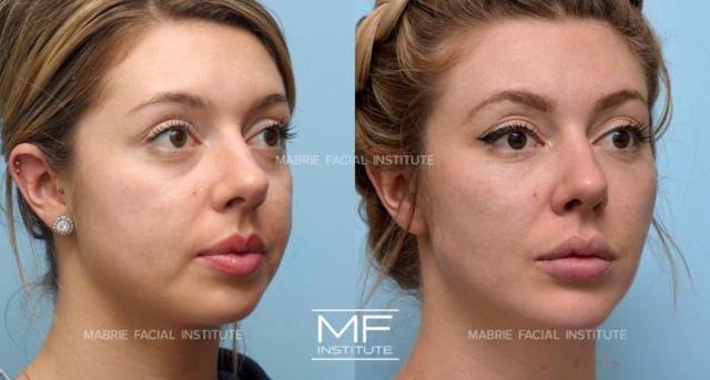 Botox result at Mabrie Facial Institute in San Francisco, CA