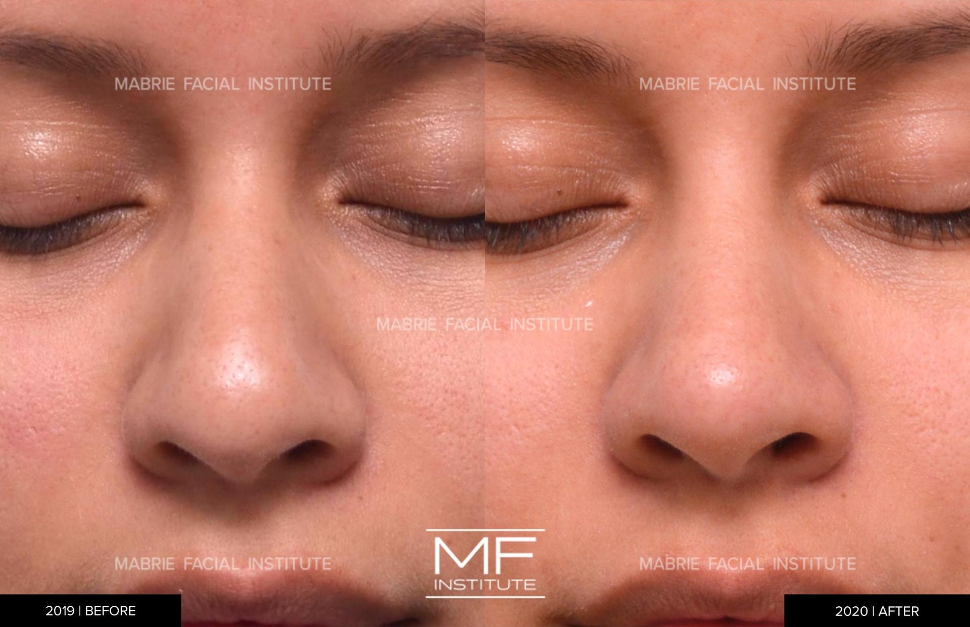Mabrie Facial Institute rhinoplasty result — San Francisco, CA