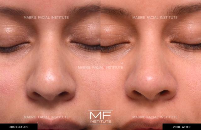 Functional Rhinoplasty result at Mabrie Facial Institute in San Francisco, CA