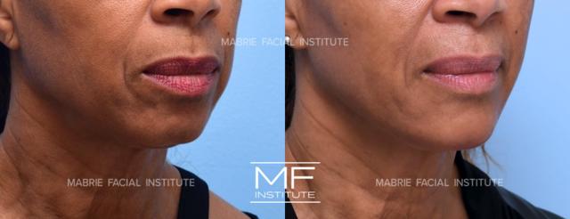 Deep Plane Facelift result at Mabrie Facial Institute in San Francisco, CA