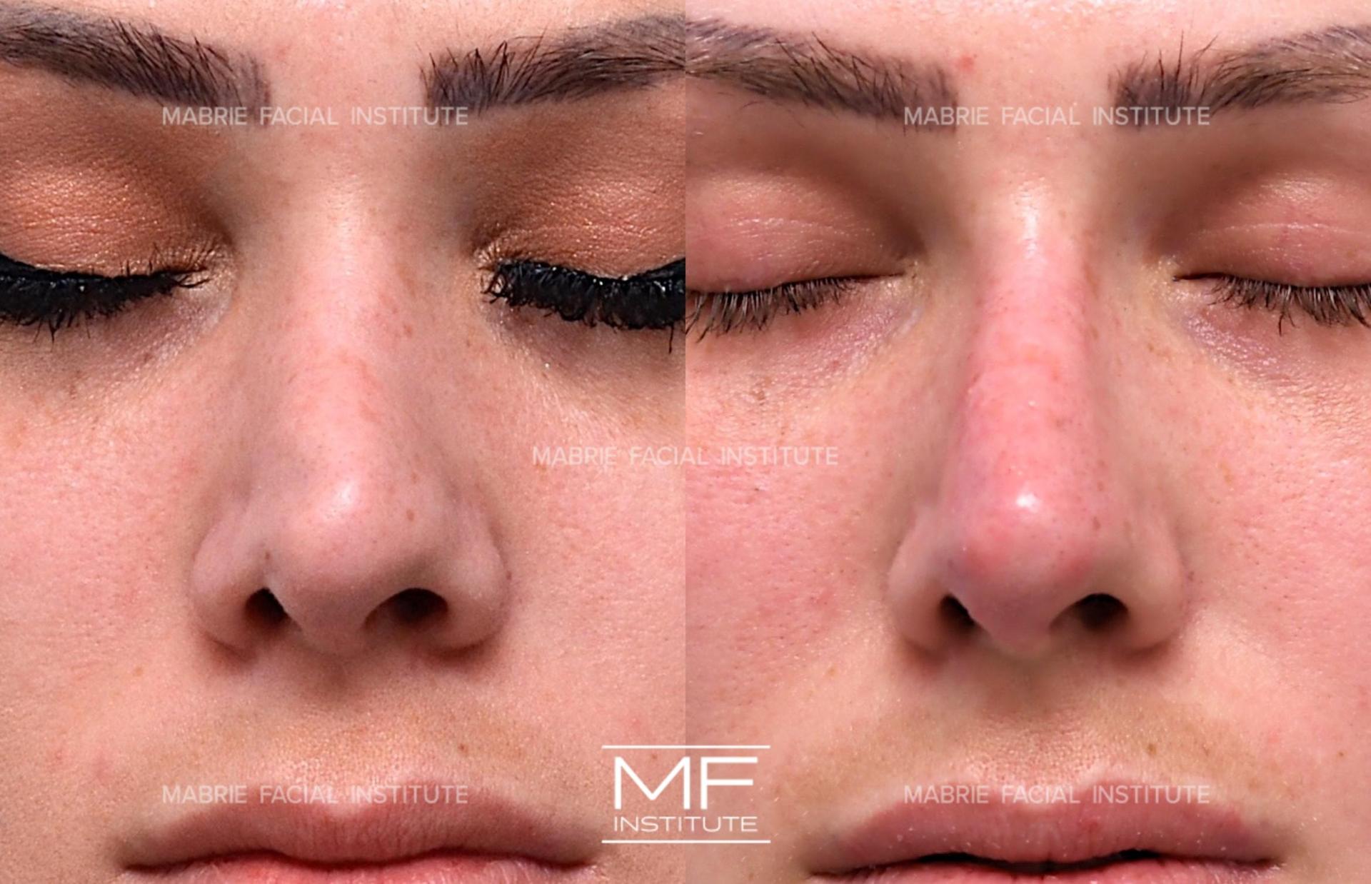 Mabrie Facial Institute rhinoplasty result — San Francisco, CA