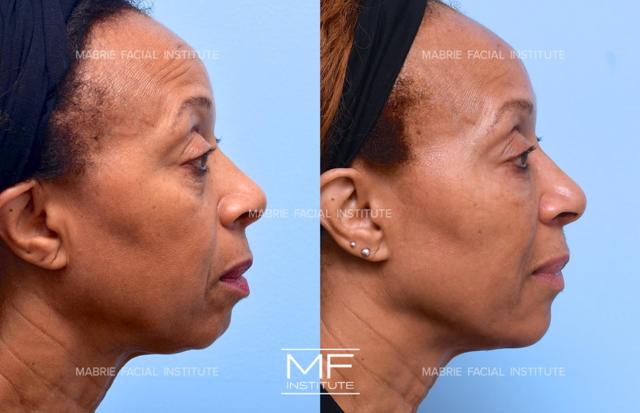 Deep Plane Facelift result at Mabrie Facial Institute in San Francisco, CA