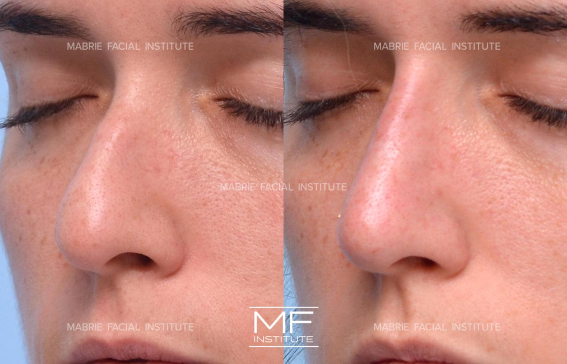 Mabrie Facial Institute rhinoplasty result — San Francisco, CA