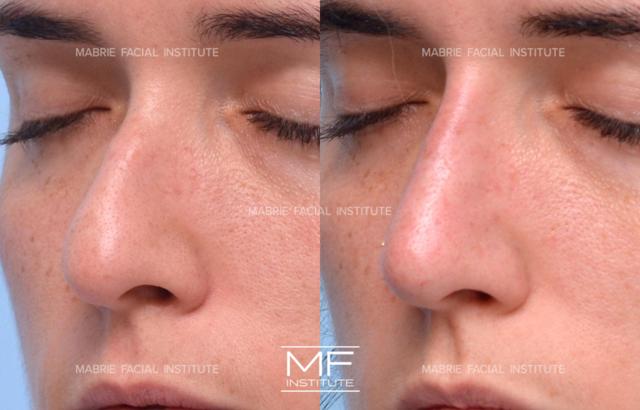 Functional Rhinoplasty result at Mabrie Facial Institute in San Francisco, CA