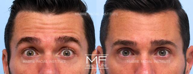 Botox result at Mabrie Facial Institute in San Francisco, CA