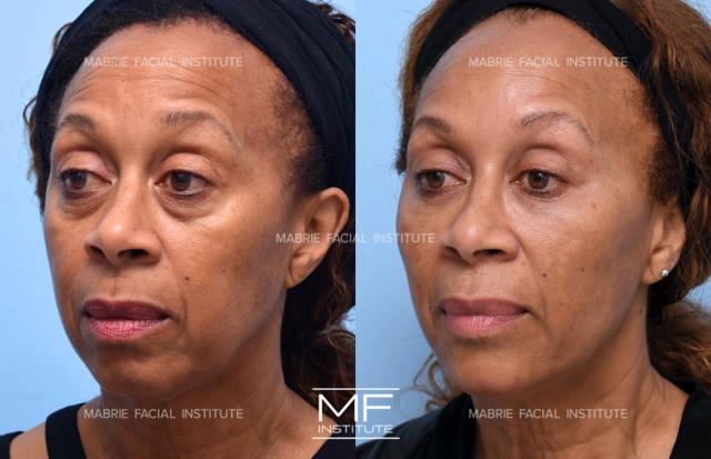 Deep Plane Facelift result at Mabrie Facial Institute in San Francisco, CA