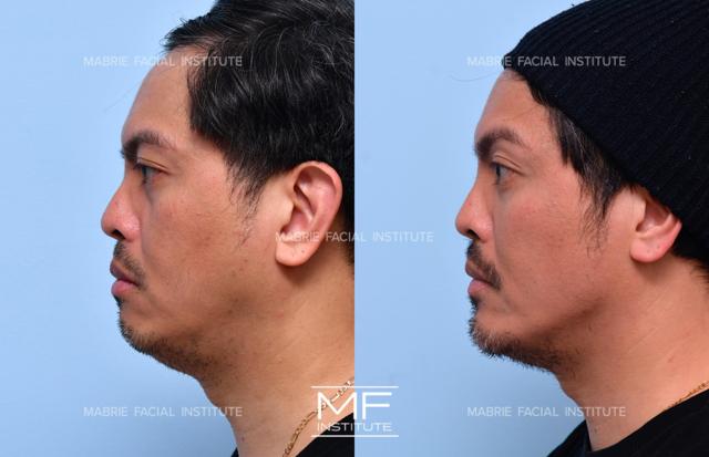 Brow Lift result at Mabrie Facial Institute in San Francisco, CA