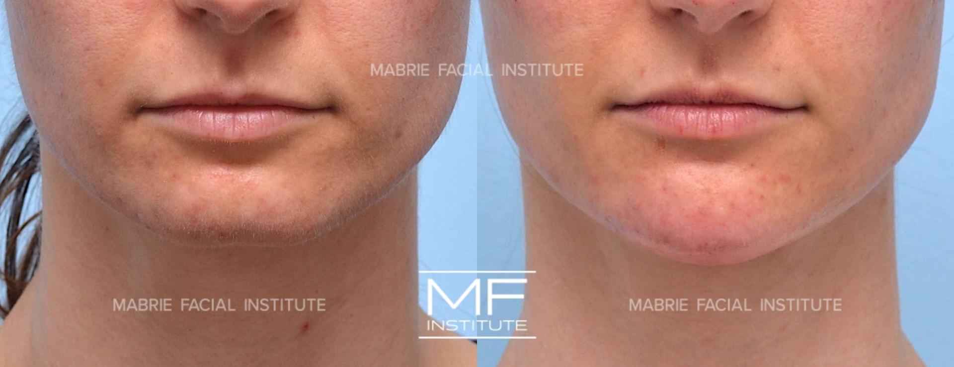 Mabrie Facial Institute chin implant result — San Francisco, CA