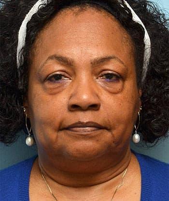 Blepharoplasty before at Mabrie Facial Institute in San Francisco, CA