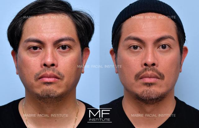 Brow Lift result at Mabrie Facial Institute in San Francisco, CA