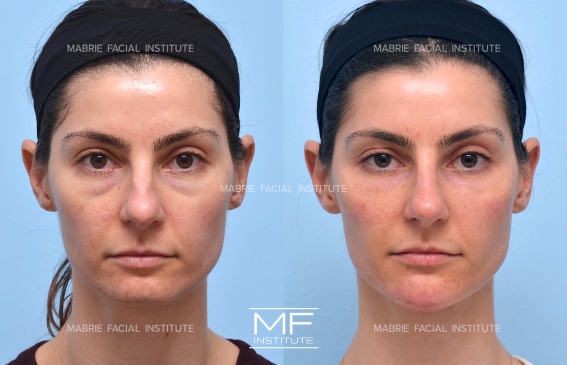Mabrie Facial Institute chin implant result — San Francisco, CA