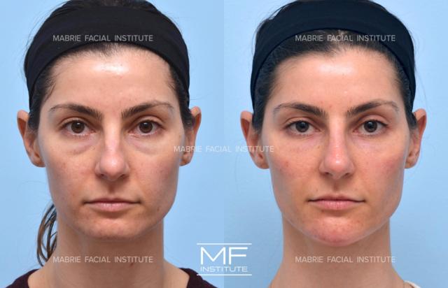 Chin Implant result at Mabrie Facial Institute in San Francisco, CA