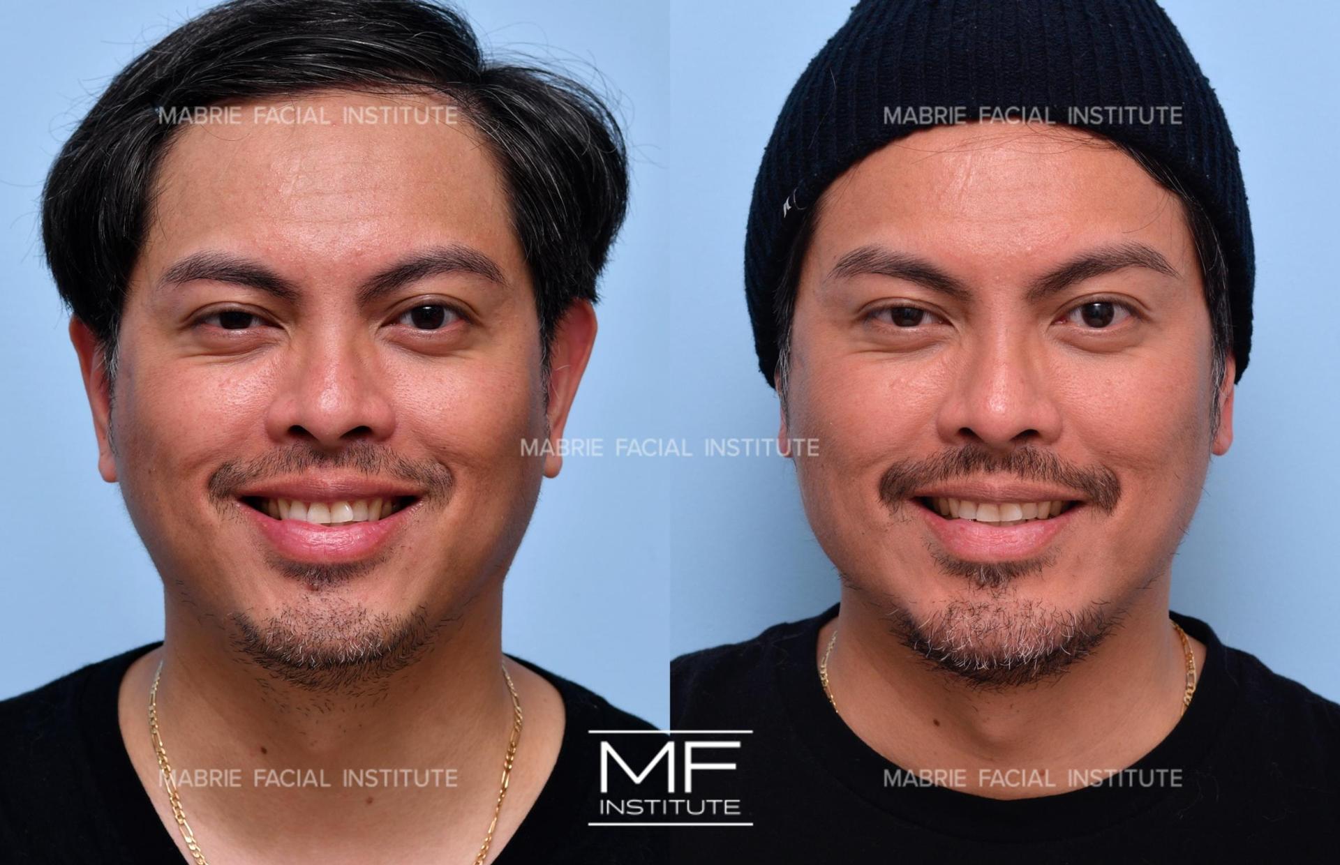 Mabrie Facial Institute brow lift result — San Francisco, CA