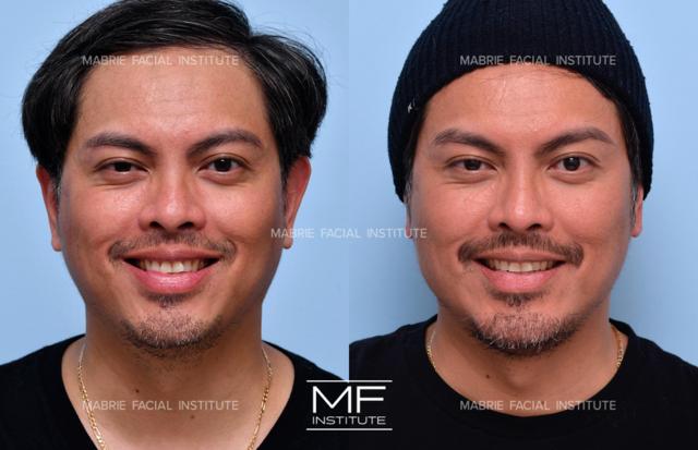 Brow Lift result at Mabrie Facial Institute in San Francisco, CA
