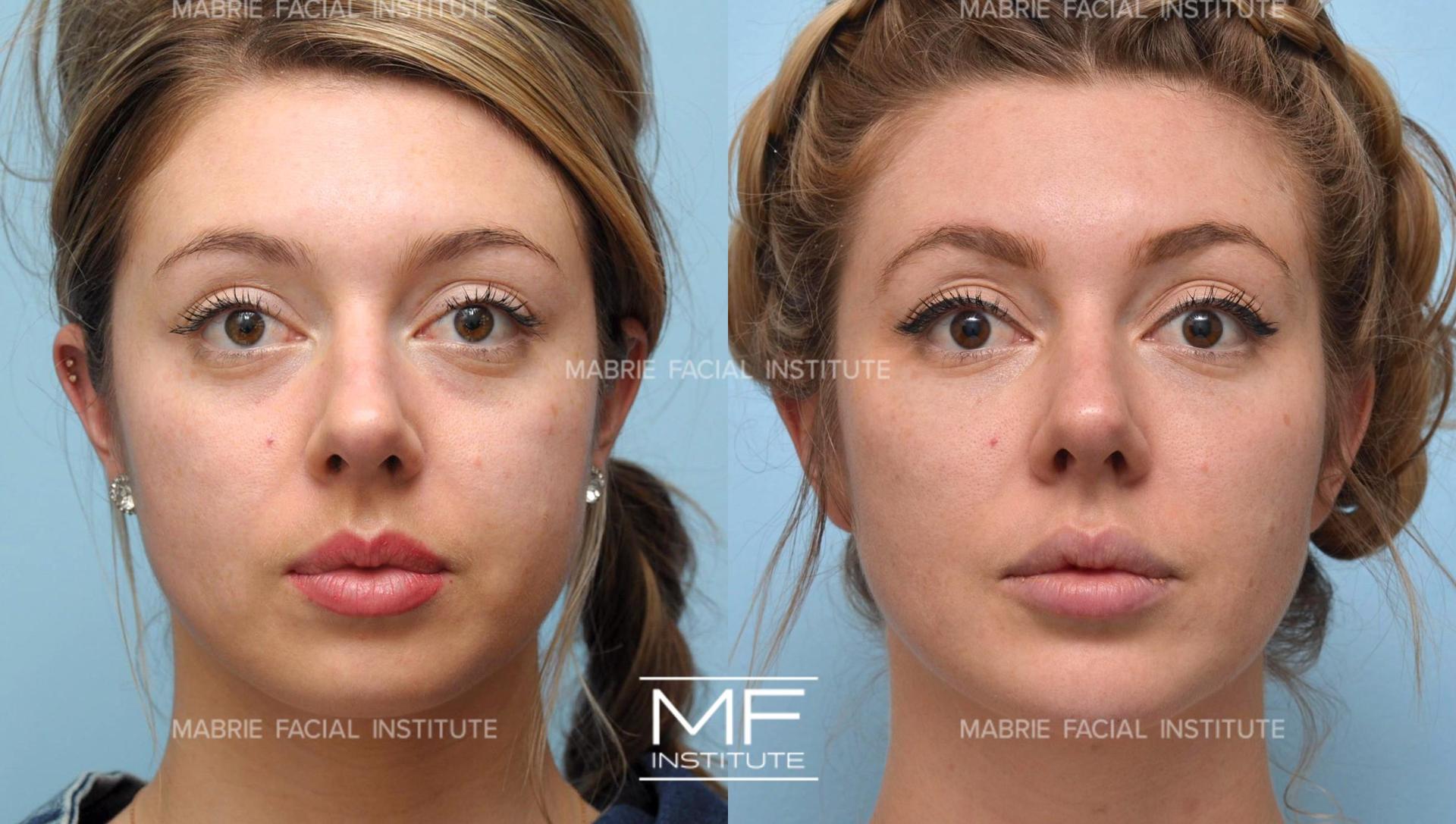 Mabrie Facial Institute botox result — San Francisco, CA
