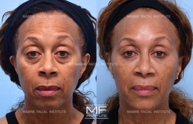Deep Plane Facelift result at Mabrie Facial Institute in San Francisco, CA